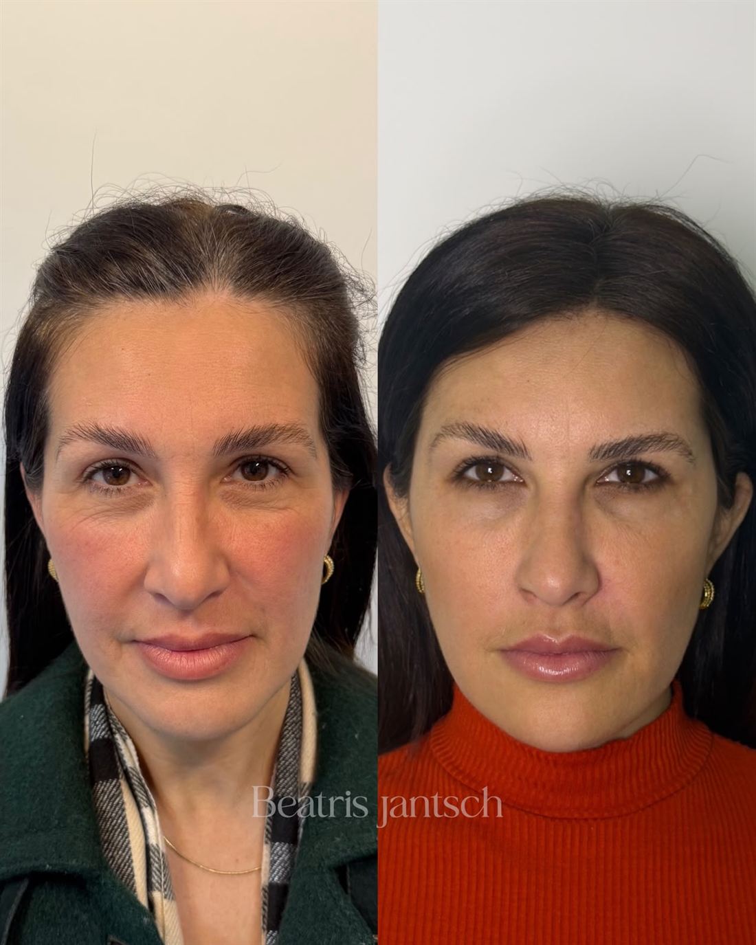 Antes e depois — caso 5